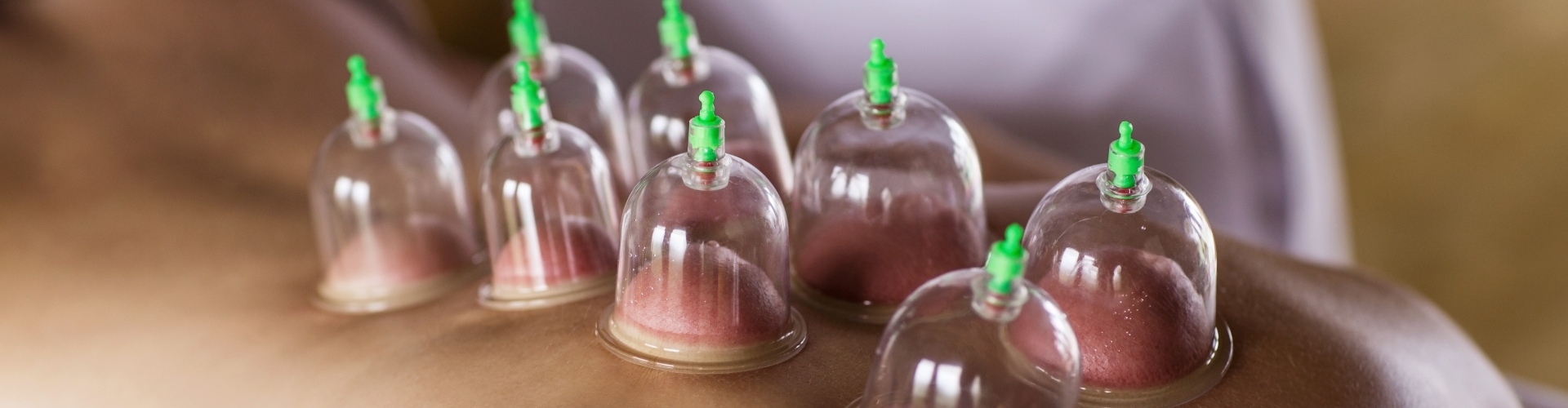 cupping-Complete-Game-Physical-Therapy-North-Chelmsford-MA-1920x500